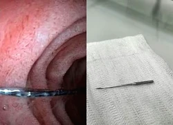 Bé trai 11 tuổi suýt mất mạng vì nuốt kim may đồ dài 4cm