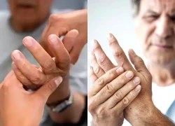 Dấu hiệu thầm lặng cảnh báo tắc nghẽn mạch máu