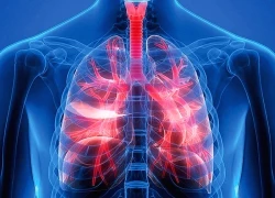 Nhận biết bệnh phổi tắc nghẽn mạn tính