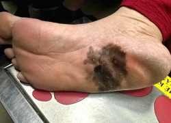 Nhiều người đổ xô đi khám vì lo sợ ung thư tế bào hắc tố gan chân