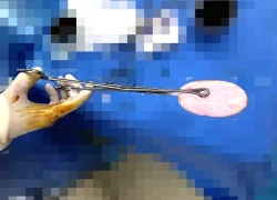 Bé gái 12 tuổi nhập viện với vùng kín chảy máu