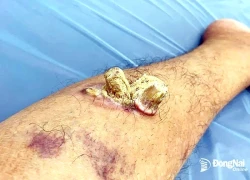 Người đàn ông bị bệnh 'người cây' cực hiếm gặp