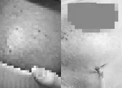 Biến dạng bầu ngực, hoại tử vì tiêm filler nâng cấp vòng 1