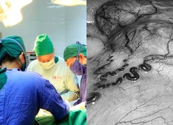 Một bệnh nhân cùng lúc phát hiện mắc 2 khối u ác tính