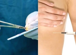 Tiêm filler nâng ngực đón Tết, người phụ nữ nhập viện vì áp xe nặng