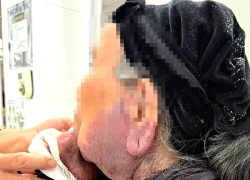 Phẫu thuật cắt khối u mạch kích thước lớn vùng môi đã hoại tử