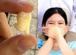Răng khôn 'nhảy chân sáo' gây sốt MXH: Bác sĩ giải thích khi nào nhổ