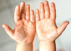 Sở Y tế TPHCM cảnh báo tác nhân EV71 xuất hiện trở lại