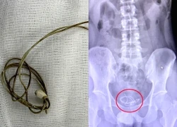 Gắp dây sạc trong bàng quang nam sinh 16 tuổi