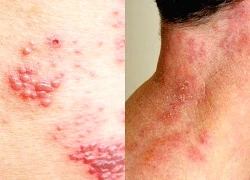 Lý do người lớn tuổi dễ mắc bệnh zona thần kinh