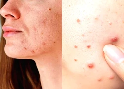 Vì sao phụ nữ mãn kinh vẫn bị mụn?