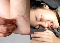 5 dấu hiệu bạn đã nhiễm ký sinh trùng, không nên chủ quan