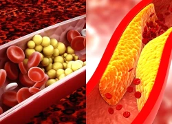 5 lưu ý giúp ngăn ngừa cholesterol cao và phòng tránh đột quỵ
