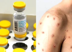 Anh ghi nhận ca đầu tiên nhiễm chủng mới của virus đậu mùa khỉ ở người