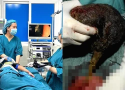 Bé gái 6 tuổi đau bụng dữ dội, bác sĩ gắp ra thứ 'đáng sợ'