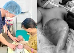 Cứu sống trẻ sơ sinh có gan, ruột nằm ngoài ổ bụng