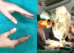 Lần đầu tiên, vi phẫu thành công cứu sống ngón tay của một thủy thủ bị đứt rời sau 25 giờ