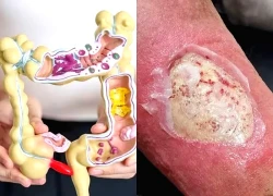 7 dấu hiệu trên da cảnh báo ung thư đại tràng, ai cũng cần biết