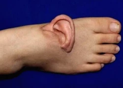 Người phụ nữ mang chiếc tai đứt rời được gắn tạm ở bàn chân suốt 5 tháng