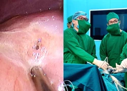 Phẫu thuật cấp cứu bệnh nhi 13 tuổi bị thủng ổ loét dạ dày tá tràng và lời cảnh tỉnh từ bác sĩ