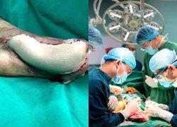 Nam bệnh nhân suýt mất bàn chân vì không biết mắc đái tháo đường