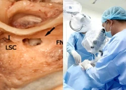 Bác sĩ cảnh báo 'điểm mù' CT: Có thể làm ca cấy ốc tai thất bại