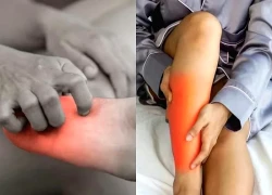 Bàn chân xuất hiện 4 dấu hiệu này, cẩn thận mỡ máu tăng bất thường