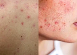 Da nổi mụn do nóng gan? Nên uống gì để thanh lọc và cải thiện làn da