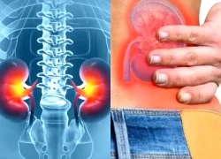 Những loại thực phẩm rất tốt nhưng ăn nhiều lại hủy hoại thận