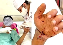 Nối liền thành công tay một bệnh nhân bị đứt lìa