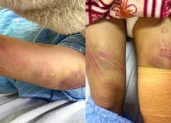 Nữ sinh lớp 7 ở Nghệ An nhập viện nghi do bị bố bạo hành