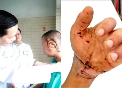 Phẫu thuật cắt bỏ khối u sợi thần kinh gần 1kg gây biến dạng mặt