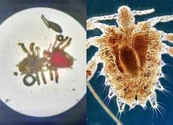 Quý ông tá hỏa phát hiện cả đàn rận "sống nhờ" ở vùng kín