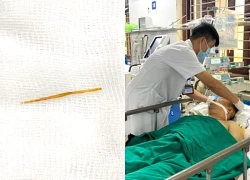 Thủng ruột do thói quen rất nhiều người mắc