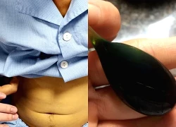 Uống mật cá trắm để tăng sinh lực, người đàn ông 38 tuổi nguy kịch