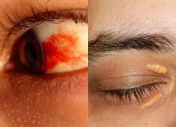 Dấu hiệu mỡ máu ở mức nguy hiểm hiện rõ ở mắt