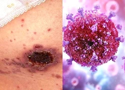 Những ca phát hiện HIV khiến bác sĩ 'giật mình'