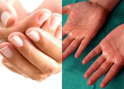 Ra mồ hôi tay chân nhiều cảnh báo những bệnh lý nào?