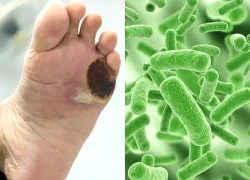 Loại vi khuẩn 'ăn mòn' mô mềm, khiến da hoại tử sau cơn sốt cao