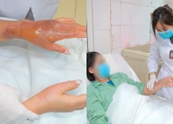 Nổ hóa chất thông bồn cầu đêm giáng sinh, người phụ nữ bỏng nặng