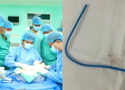 Ống thông trôi vào tim: Người phụ nữ suýt chết vì catheter bị bỏ quên