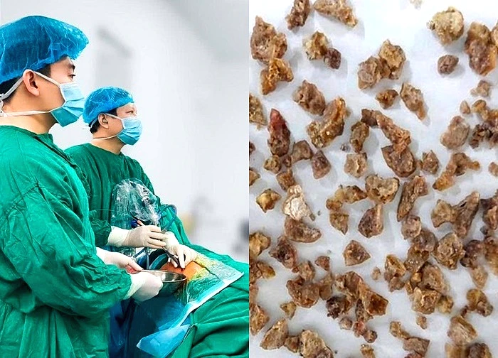 Phẫu thuật thành công ca sỏi san hô phức tạp trên nền xơ gan