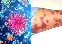 Số ca mắc bệnh do não mô cầu tăng, chuyên gia y tế khuyến cáo gì đến cộng đồng?