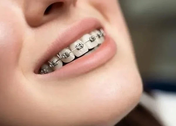 Một số lưu ý khi niềng răng để hàm răng luôn trắng khỏe