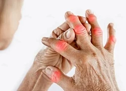 8 loại thực phẩm cần tránh khi bị bệnh gout