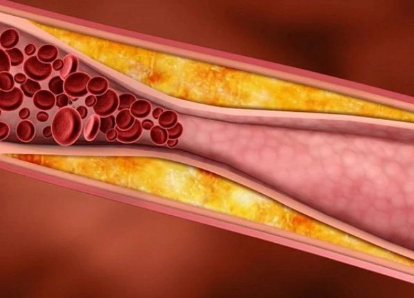 Mỡ máu không phải nguyên nhân chính gây ra đột quỵ