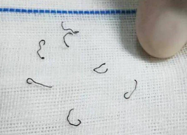 Sau cắt trĩ, người phụ nữ phải nhập viện nhổ đinh 8 lần và bị suy thận