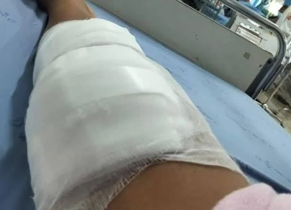 Bị rắn hổ mang chúa cắn khi hái nấm, người phụ nữ dùng tay không đánh chết rồi xách đến bệnh viện, bác sĩ choáng váng