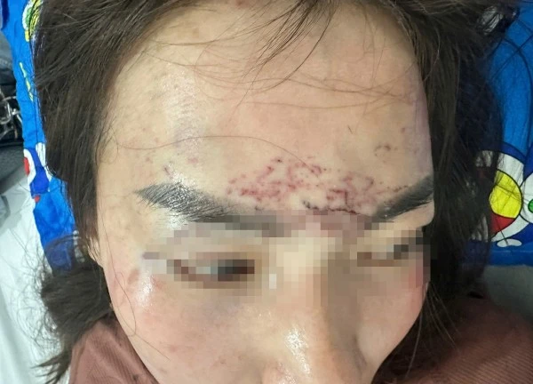 Người phụ nữ đi đường bất ngờ bị kéo lên ô tô, 'tra tấn' bằng axit và máy xăm