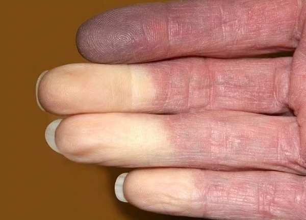 Câu hỏi thường gặp liên quan đến hội chứng Raynaud